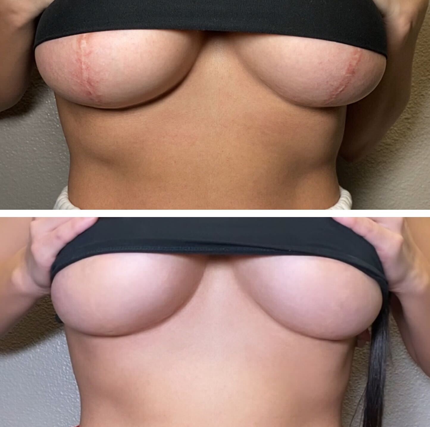 Scar camouflage treatment result